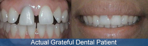 photo of an actual grateful dental patient before and after