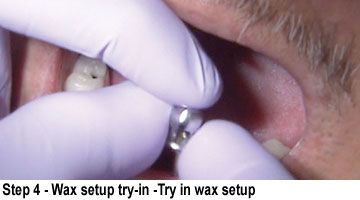 BruxZir Full-Arch Implant Prosthesis- Step 4 Wax setup try-in