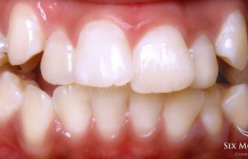 teeth before Six Month Braces treatment