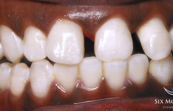 teeth before Six Month Braces treatment
