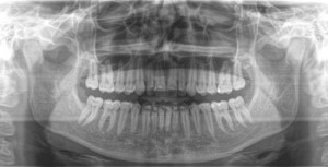 3D dental image