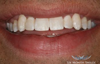 teeth after Six Month Braces treatment