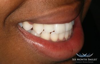 teeth after Six Month Braces treatment
