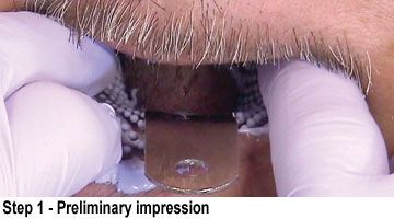 BruxZir Full-Arch Implant Prosthesis- Step 1 Preliminary impression