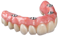 implant retained upper denture