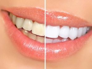 Marietta GA teeth before and after whitening