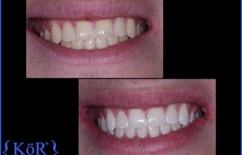 teeth before and after Kor Whitening treatment