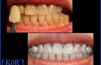 teeth before and after Kor Whitening treatment