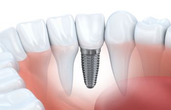 Dental Implant Marietta GA