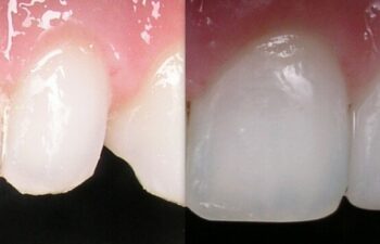 Patient's Teeth Before and After Veneers Marietta, GA