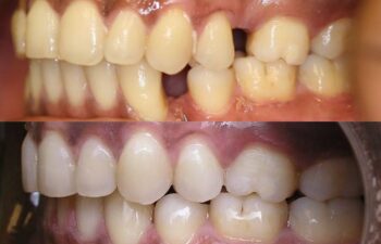 Patient's teeth before and after gap correction Marietta, GA