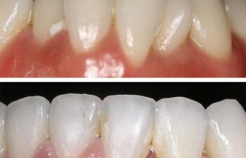 Patient's Teeth Before and After Orthodontic Treatment Marietta, GA