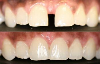 Patient's teeth before and after gap correction Marietta, GA