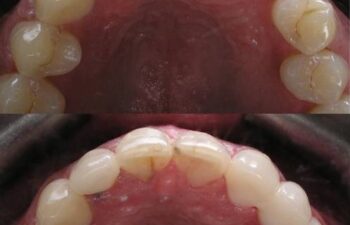 Patient's teeth before and after having dental bridge applied Marietta,GA