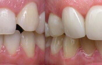 Patient's Teeth Before and After Having Dental Crowns Applied Marietta, GA