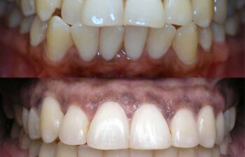 Patient's Teeth Before and After Orthodontic Treatment Marietta, GA