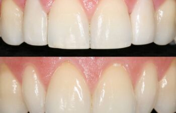 Patient's Teeth Before and After Veneers Marietta, GA