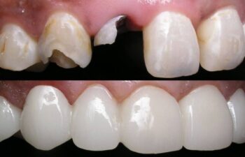 Patient's teeth before and after having dental bridge applied Marietta,GA