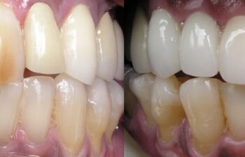 Patient's Teeth Before and After Having Dental Crowns Applied Marietta, GA